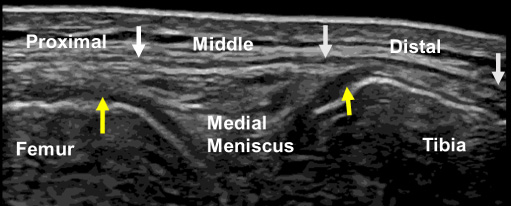 B-mode ultrasound image of the medial collateral ligament at the 0° knee position. The white arrows indicate the proximal, middle, and distal portions of the superficial medial collateral ligament, and the yellow arrows indicate the meniscofemoral (left) and meniscotibial (right) portions of the distal medial collateral ligament.