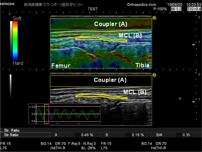 Elastographic (top) and B-mode images (bottom) of the middle portion of the superficial medial collateral ligament (MCL) at 0° knee flexion. The strain indicator and the strain ratios of the ligament and coupler are displayed. The ROI of the acoustic coupler (width, 4 cm; height, 0.5) is indicated as a yellow rectangle, and the ligament portion (length, 2 cm) is outlined in yellow.