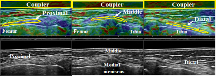 Elastographic (top) and B-mode images (bottom) of the superficial medial collateral ligament at 0° knee flexion. From left to right, the proximal, middle, and distal portions are shown. The ROI of the acoustic coupler is indicated as a yellow rectangle, and the ROI of each ligament portion is outlined in yellow.