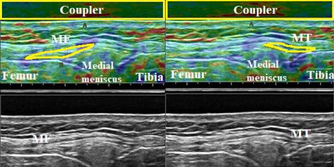 Elastographic (top) and B-mode images (bottom) of the meniscofemoral (MF, left) and meniscotibial (MT, right) portions of the deep medial collateral ligament (dMCL) at 0° knee flexion. The ROI of the acoustic coupler is indicated as a yellow rectangle, and the ROI of each ligament portion is outlined in yellow.