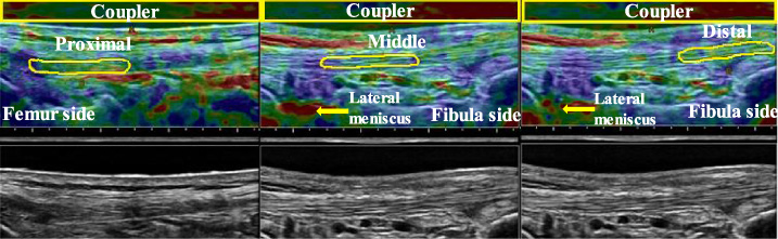 Elastographic (top) and B-mode images (bottom) of the lateral collateral ligament (LCL) at 0° knee flexion. From left to right, the proximal, middle, and distal portions are shown. The ROI of the acoustic coupler is indicated as a yellow rectangle, and the ROI of each ligament portion is outlined in yellow.