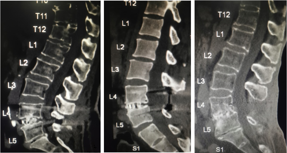 According to Mayer’s research, Grade 3, Grade 2 and Grade 1 were idectified at the sixth month after surgery (from left to right).