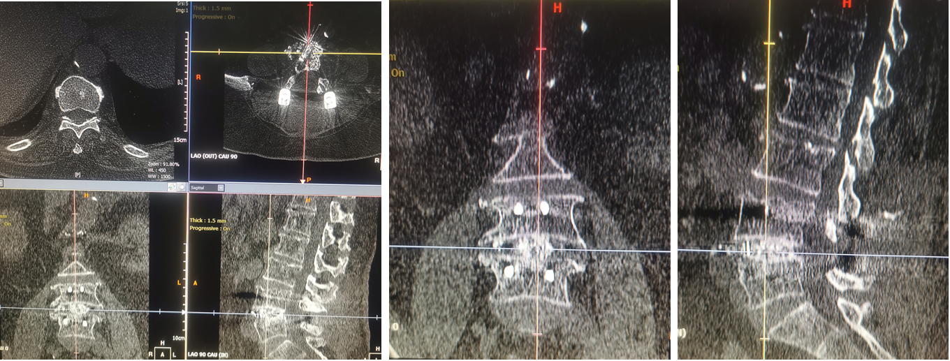 Female patient, 52 yrs, lumbar spondylolisthesis and lumbar disc herniation before surgery, and noramal patient. PLIF was carried out. At the sixth month after surgery the interbody fusion was Grade 1 according to Mayer’s research. The trabeculae were filled with interbody space.
