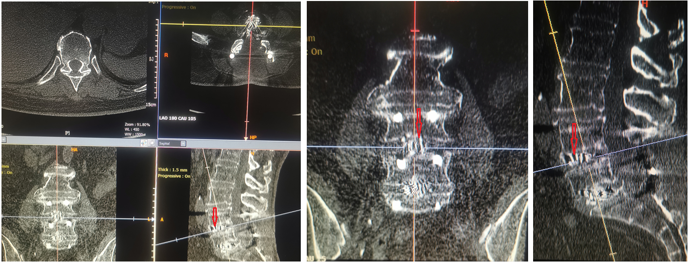 Female patient, 63 years old, with lumbar spondylolisthesis and lumbar disc herniation before surgery; osteoponia; PLIF; oral calcium 1200mg/day; activated vitamin D 800IU/day before and after sugery. At the sixth month after surgery, the interbody fusion was Grade 3 according to Mayer’s research. The red arrows show the unfused areas; and the trabeculae exhibited a palisade pattern.