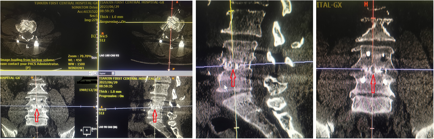 Female patient, 66 years old, with lumbar spondylolisthesis and lumbar disc herniation before surgery; osteoporosis; PLIF; oral calcium 1200mg/day; and activated vitamin D 800IU/day before and after surgery. Denosumab was injected at the sixth day after surgery. At the sixth month after surgery, the interbody fusion was Grade 2 according to Mayer’s research. The red arrows show the unfused area, which was just a small area, and the other areas were fused.