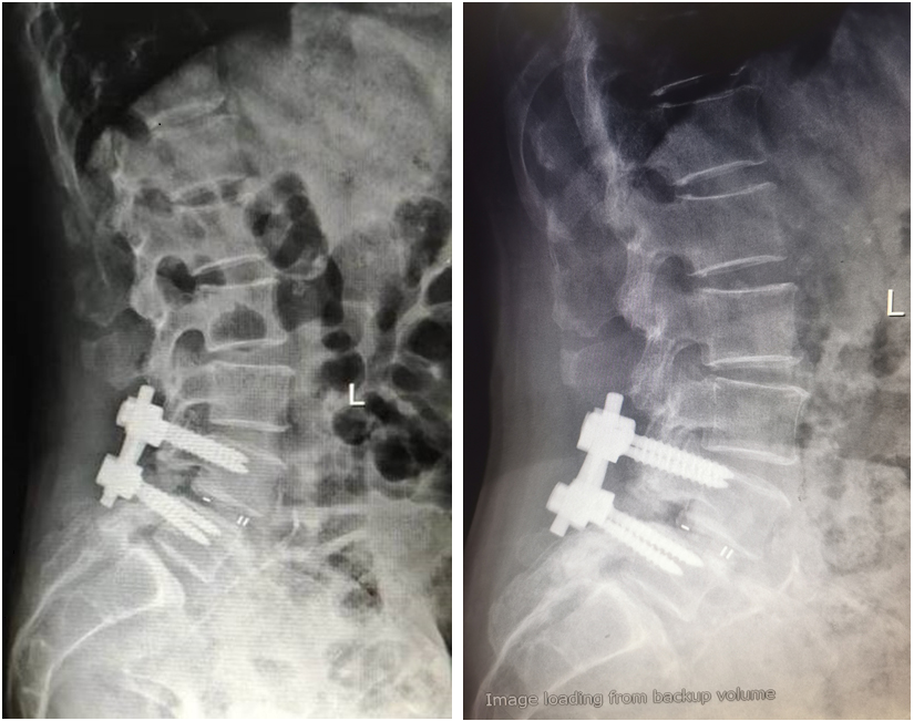 Female patient, 67 yrs, with lumbar spondylolisthesis and lumbar disc herniation before surgery; osteoponia; PLIF; oral calcium 1200mg/day; and activated vitamin D 800IU/day before and after sugery. At the third month after surgery, the screw pedicle was cut out; and fusion failure occurred.