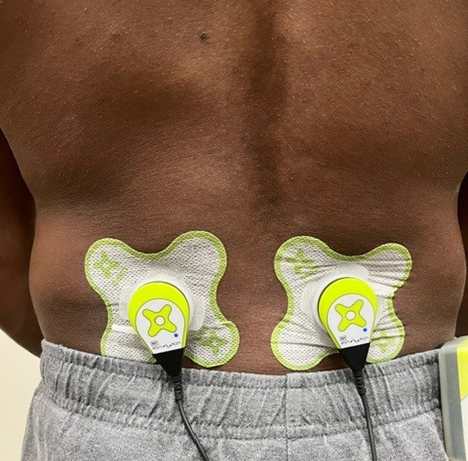 Sustained Acoustic Medicine (SAM) application to lower back. The ultrasound delivery system spreads ultrasound diathermy to the size of the star-shaped ultrasound coupling patch.