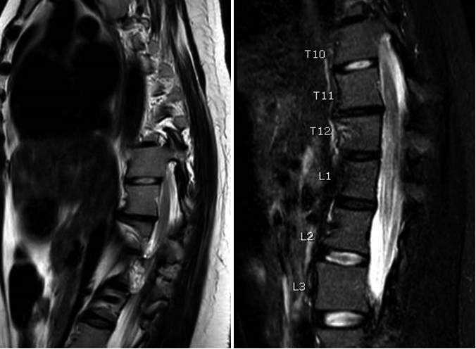 Spinal cord magnetic resonance imaging with contrast shows acute spinal cord infarction between the 11th thoracic vertebra (T11) and the 1st lumbar vertebra (L1).