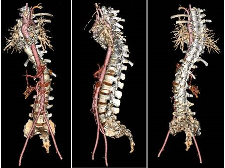 Three-dimensional reconstructed computed tomography angiogram underlines a severe grade of scoliosis without any vascular alterations.