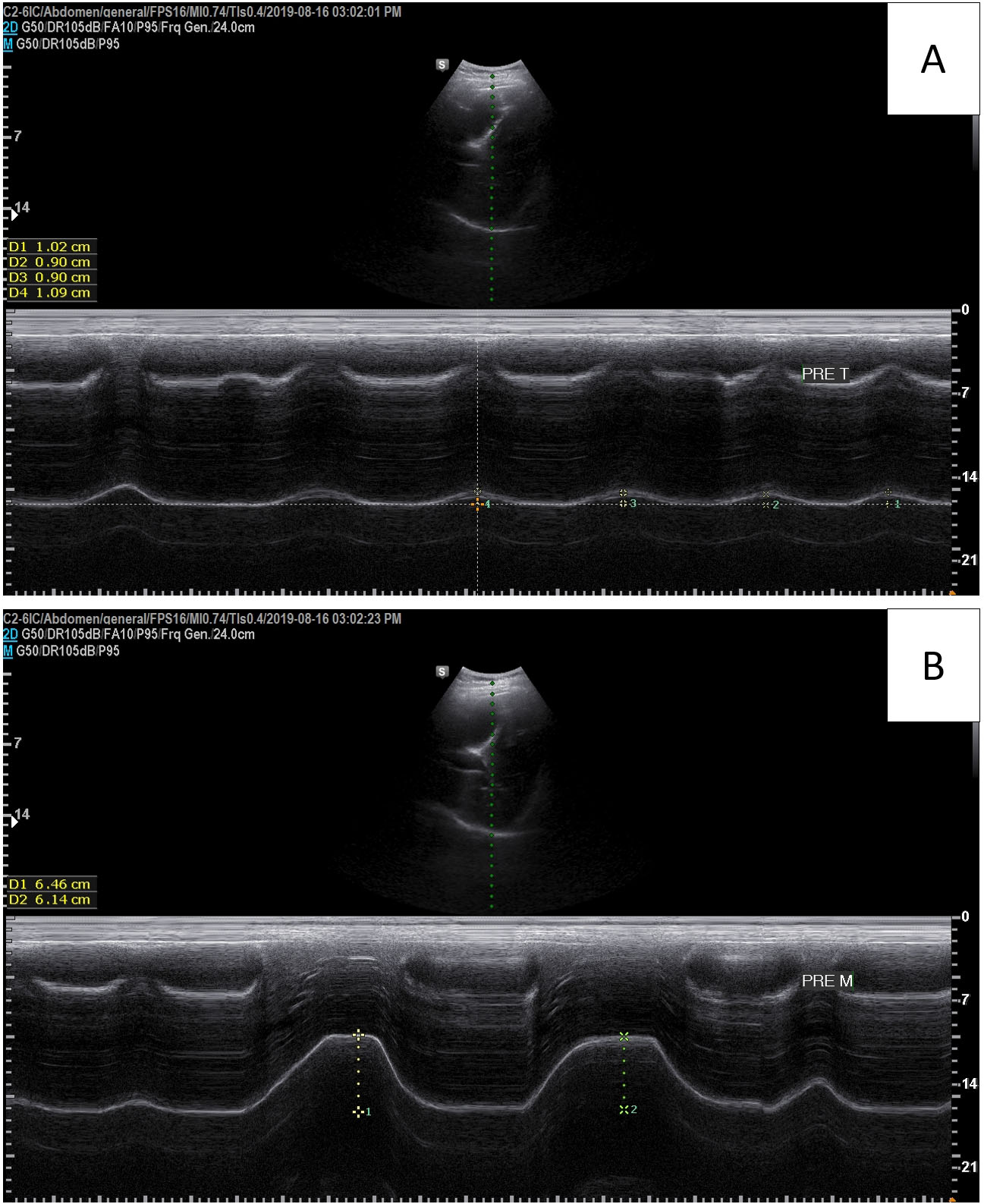 Diaphragmatic excursion measured by an ultrasound system. (A): Tidal breathing, (B): Deep breathing.