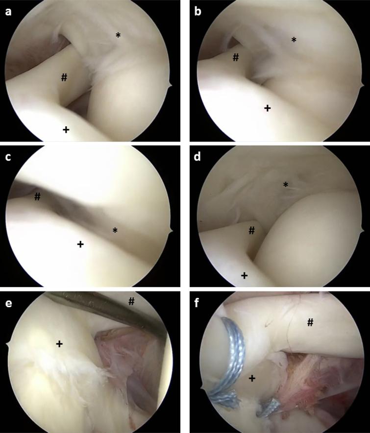 Intraoperative arthroscopic images of a 31-year-old patient with GIRD of 20 degrees and a partial articular sided SSP tear in combination with a SLAP II lesion due to postero-superior impingement. (a–c) Intraarticular arthroscopic view of the postero-superior cuff (*), the biceps tendon (#) and the SLAP complex (+) with the patient’s arm in ABER position of 0∘ (a), 45∘ (b) and 90∘ (c) showing the impingement of the postero-superior cuff against the SLAP complex at 90∘ ABER. (d) Intraarticular arthroscopic view of the partial articular sided SSP tear. (e) Intraarticular arthroscopic view of the SLAP II lesion. (f) Intraarticular arthroscopic view after SLAP repair with two knotless pushlock anchors. ABER abduction external rotation; GIRD glenohumeral internal rotation deficit; SLAP superior labrum anterior-to-posterior; SSP supraspinatus tendon.