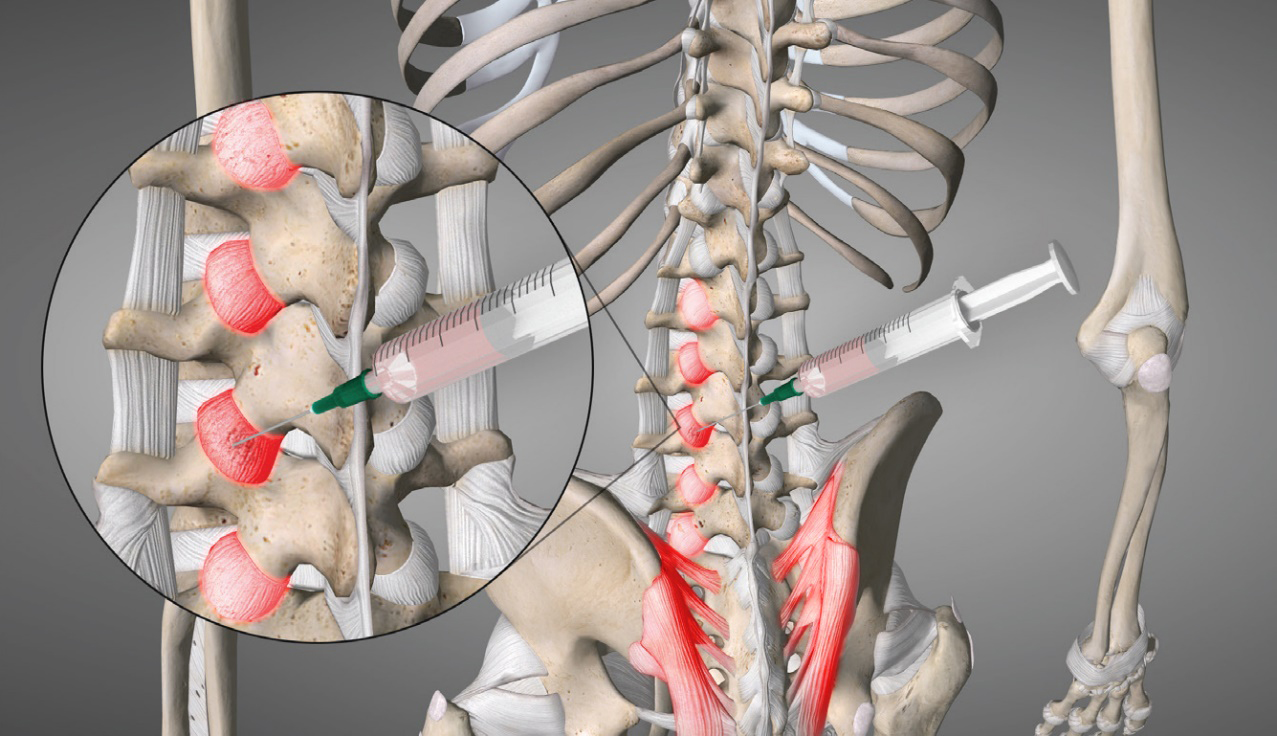 Prolotherapy treatment for the low back may involve injections to the capsular, sacroiliac, and/or other ligaments and entheses.