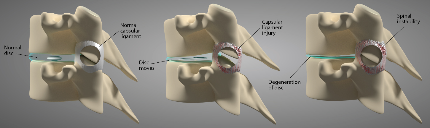 Capsular ligament injury leads to the development of spinal instability, which can give rise to disc protrusions and eventual disc degeneration in the process.