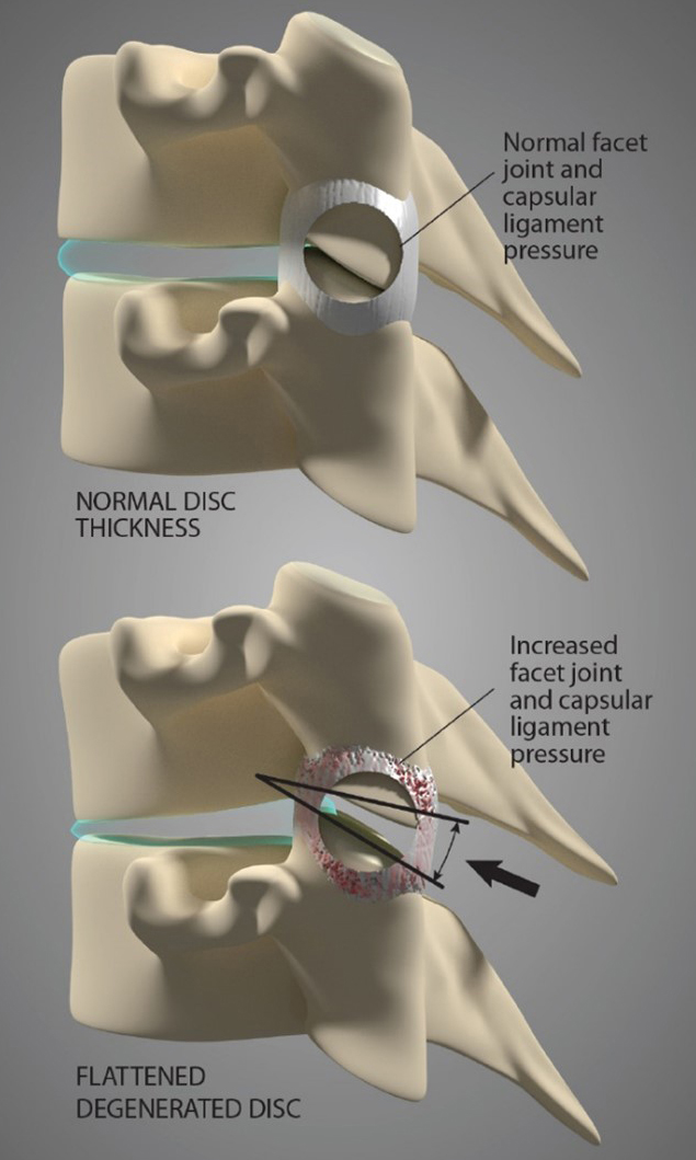 As the facet joint capsular ligaments loosen, the spinal segments begin to flex more during normal motions. Over time, this will increase pressure in the facet joint(s), as well as accelerate degeneration of the intervertebral disc(s). 