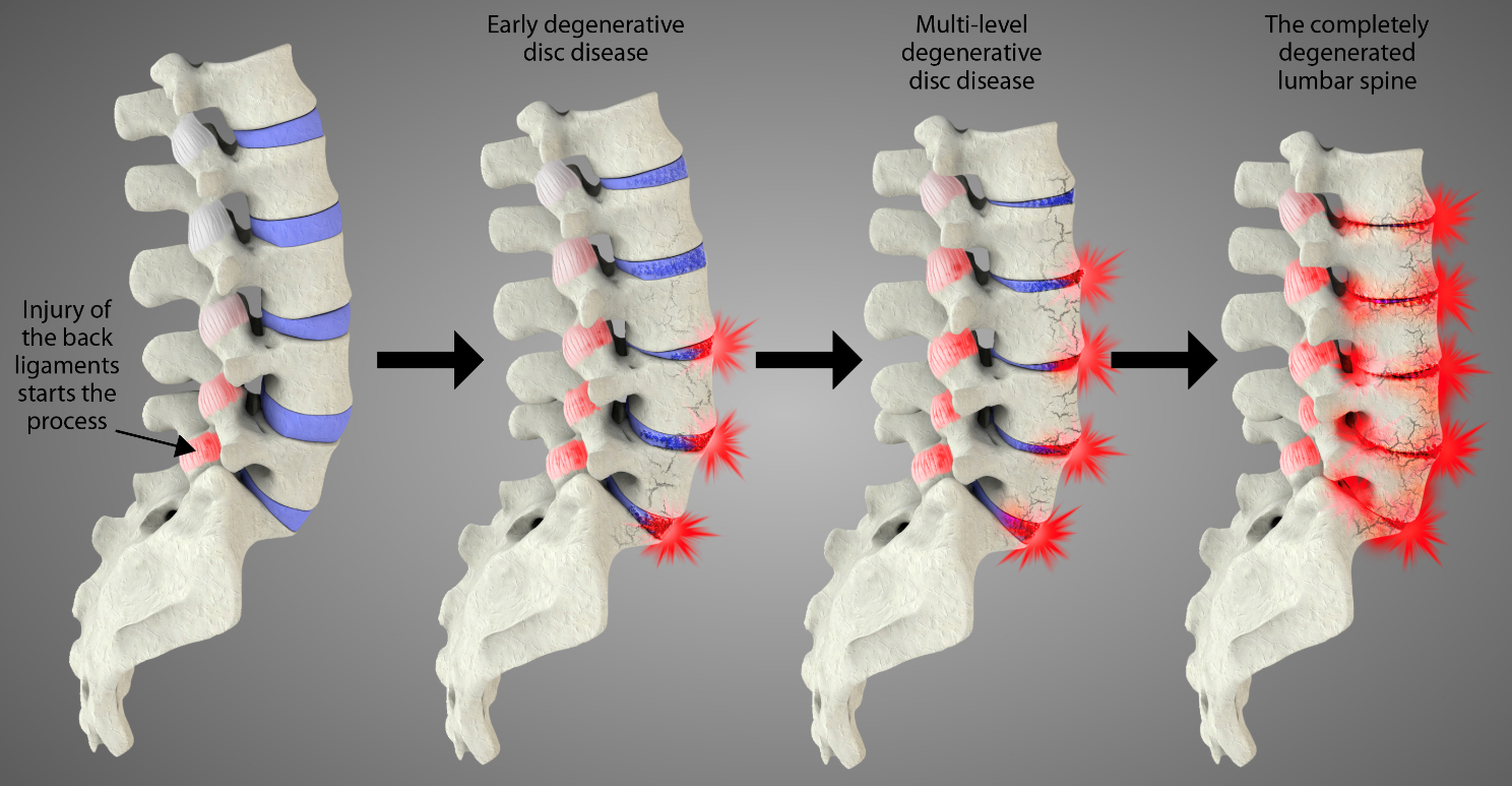 The progression of degeneration in the lower back starts with an initial injury to one or more spinal ligaments. Over time, the process progresses to involve more spinal segments. Eventually, unresolved spinal instability can cause multi-level degeneration of the lumbar spine. 