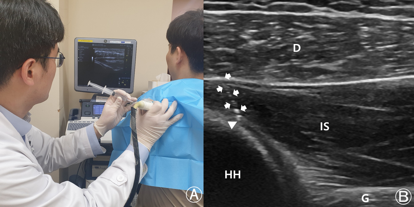 Ultrasound (US)-guided intra-articular (IA) injection techniques. (A) US-guided IA injection with the posterolateral approach. (B) Image of the US on the shoulder. D, deltoid; IS, infraspinatus; G, glenoid; HH, humeral head. Arrows indicate the needle and arrowhead indicates the needle tip in the IA space.