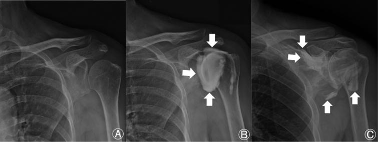 Shoulder posterior-anterior view. (A) Before intra-articular (IA) steroid injection. (B) After IA corticosteroid injection. (C) Leakage of contrast medium to outside the articular space. Arrows indicate the contrast medium.