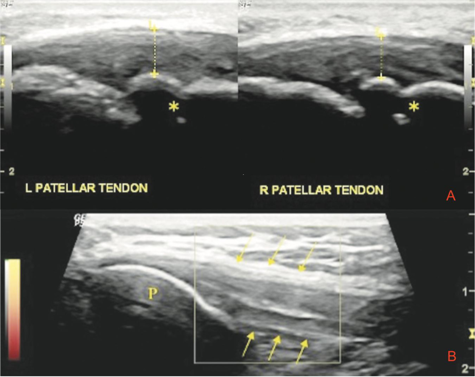 A. Evaluation of the attachment site of the patellar tendon to the tibial tuberosity on the left and right sides in Osgood-Schlatter disease. The left patellar tendon was measured to be thicker than the right side (5.23 mm vs. 4.83 mm). Cortical irregularity in the tibial tuberosity is notable bilaterally (asterisk). B. Ultrasound image of a patient’s knee with Jumper’s knee showing thickening and a hypoechoic area at the proximal part of the patellar tendon [16].