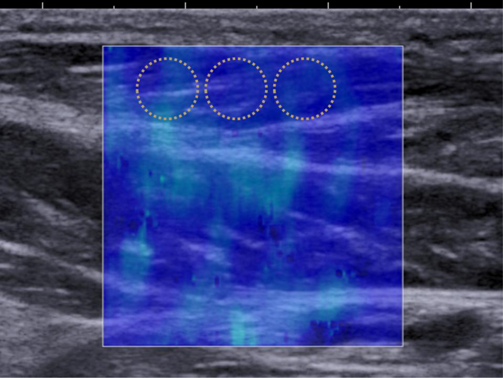 Shear wave elastography image and measurement of Young’s modulus. This image shows the abductor hallucis. The Young’s modulus in the area of interest enclosed in the square is displayed using color mapping. Three circled areas are set within the area of interest and the average Young’s modulus in each circle is measured in kPa. The average value of the 3 areas is set as the Young’s modulus for each image.