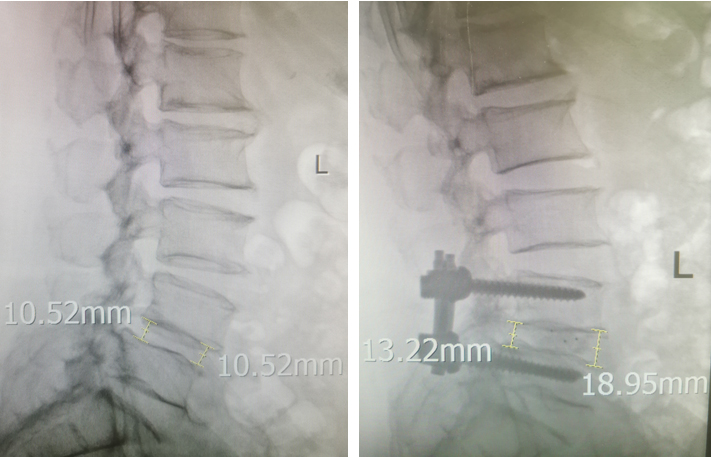 HIS before and after surgery.