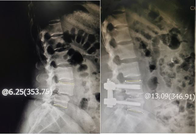 SSA before and after surgery.