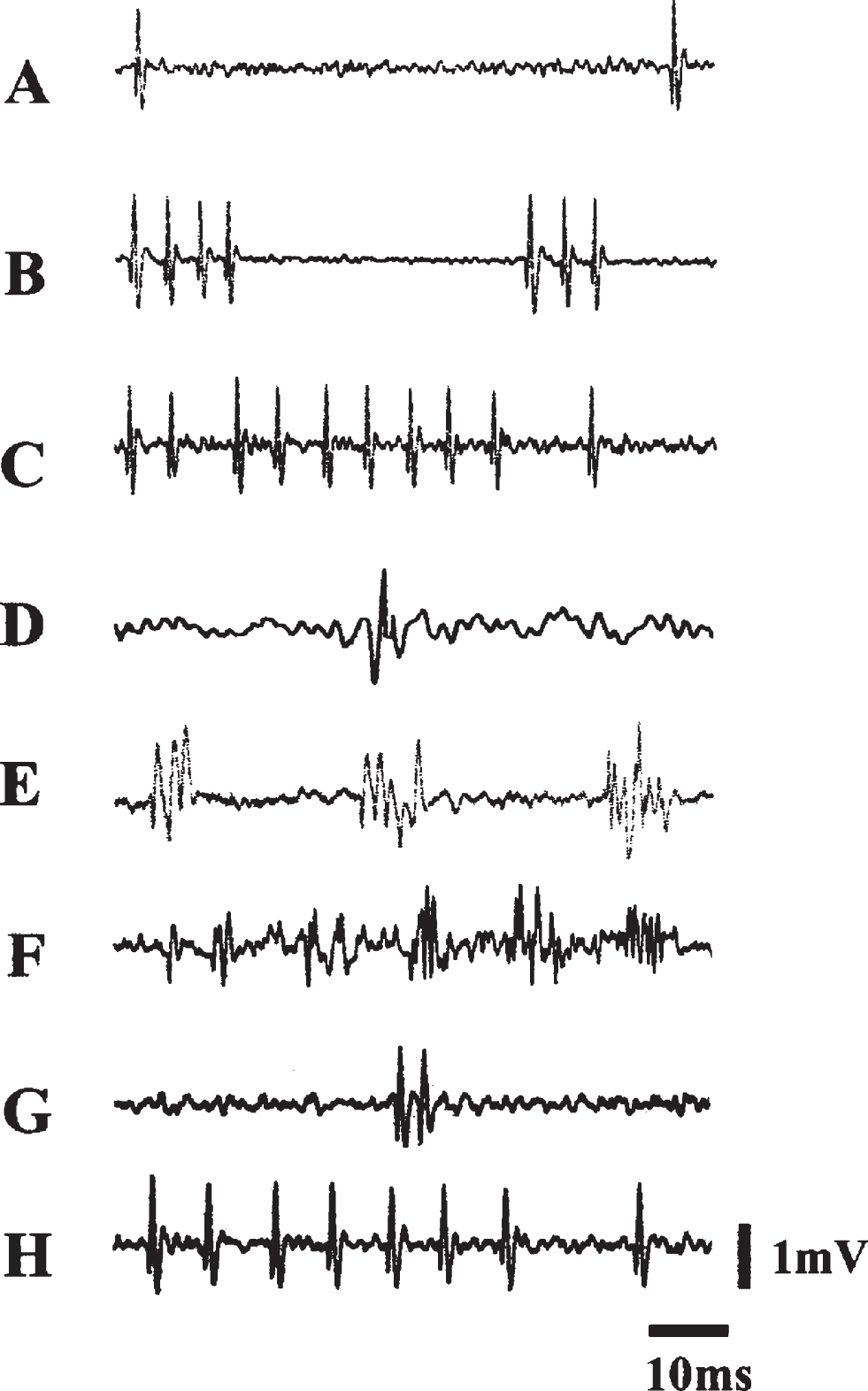 Electrophysiological Activities Over the Course of 99 Days Postlesion. Samples of spontaneous electrical activity in VMN before and after lesions. (A), (B), and (C) were recorded from VMN before lesions: (A) A slow and irregular discharge pattern; (B) a phasic firing pattern; (C) a fast firing pattern. (D–H) were recorded after lesions: (D) was recorded at 42 days postlesion; (E) was recorded 64 days postlesion. Note that (D) and (E) lack complete form of a discharge characteristic of an extracellular recording. (E) and (F) exhibit both normal and abnormal forms of discharge; (G) and (H) exhibit normal forms of discharge from birds that survived 99 days. Courtesy of Cheng et al. J Neurobiol. 2004; 60: 197-213.