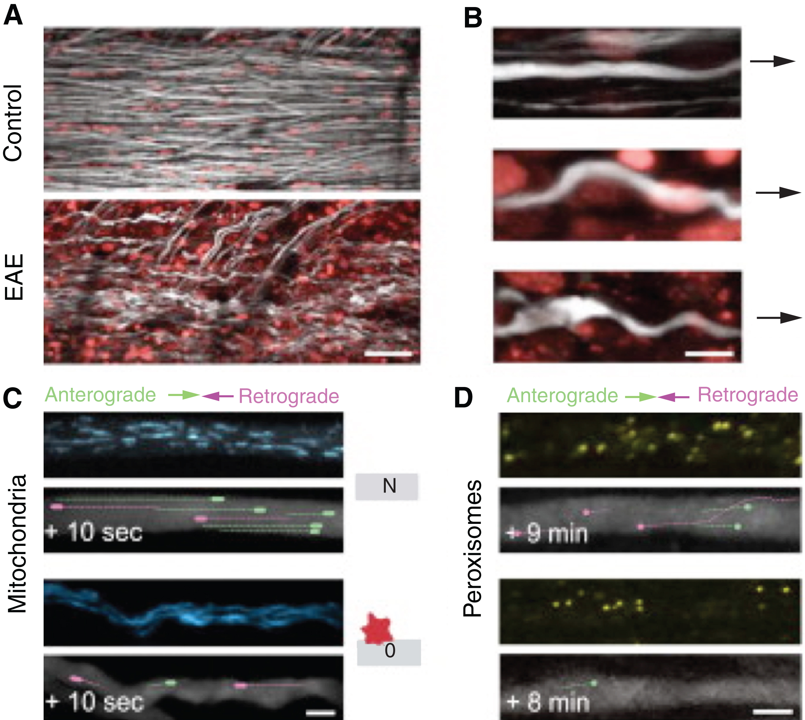 In vivo of Organelle Transport in neuroinflammatory lesions (A) In vivo two-photon image of the spinal cord of a control Thy1 -YFP-16 × Thy1-MitoCFP-P mouse (top) and a Thy1-YFP-16 × Thy1-MitoCFP-P mouse 2 days after onset of EAE (bottom; axons, white; nuclei labeled by in vivo application of Nuclear-ID Red, red; mitochondrial channel not shown). (B) Magnified views of axons from neuroinflammatory lesions illustrating different stages of axon morphology (N, axon from a control mouse; normal-appearing axon within an inflammatory lesion and swollen axon within an inflammatory lesion. (C and D) In vivo two-photon time-series images of control axons (top) and stage 0 axons imaged 2 days after onset of EAE (bottom) with moving mitochondria (C), in Thy1-YFP-16 × Thy1-MitoCFP-P mice, and peroxisomes (D), in Thy1-OFP-3 × Thy1-PeroxiYFP-376 mice, represented as pseudo-colored overlays (lines represent tracks during the indicated time period). Note that anterograde transport is more significantly affected than retrograde transport (adapted with requested permission from Ref. 58).