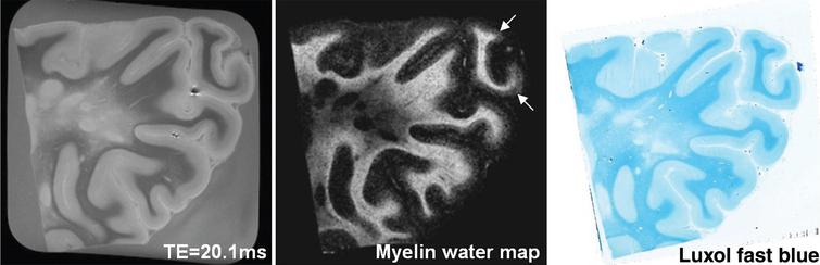 Example of a 7T (a) TE = 20.1 ms image and (b) myelin water map, and (c) corresponding luxol fast blue histology image of the parieto-occipital region of an MS patient. A good qualitative correspondence is observed between the myelin water map and histology stain for myelin. The normal prominent myelination of the deeper cortical layers (arrows) is also visible on the myelin water image(Fig. 2, Laule C, Kozlowski P, Leung E, Li DK, Mackay AL, Moore GR. Myelin water imaging of multiple sclerosis at 7 T: Correlations with histopathology. Neuroimage. 2008;40:1575-80).