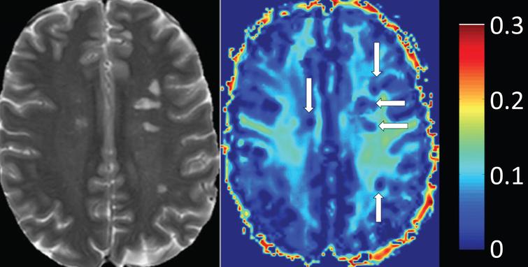 Heat map of myelin water fraction. Left side: T2w image of a Multiple-Sclerosis (MS) patient. Right side: heat map of a myelin water imaging (MWI). T2-hyperintense MS-lesions show clear reductions of myelin water fraction (MWF) (white arrows, right side) (Fig. 2, Faizy TD, Thaler C, Kumar D, Sedlacik J, Broocks G, Grosser M, et al. Heterogeneity of Multiple Sclerosis Lesions in Multislice Myelin Water Imaging. PLoS One. 2016;11(3):e0151496).