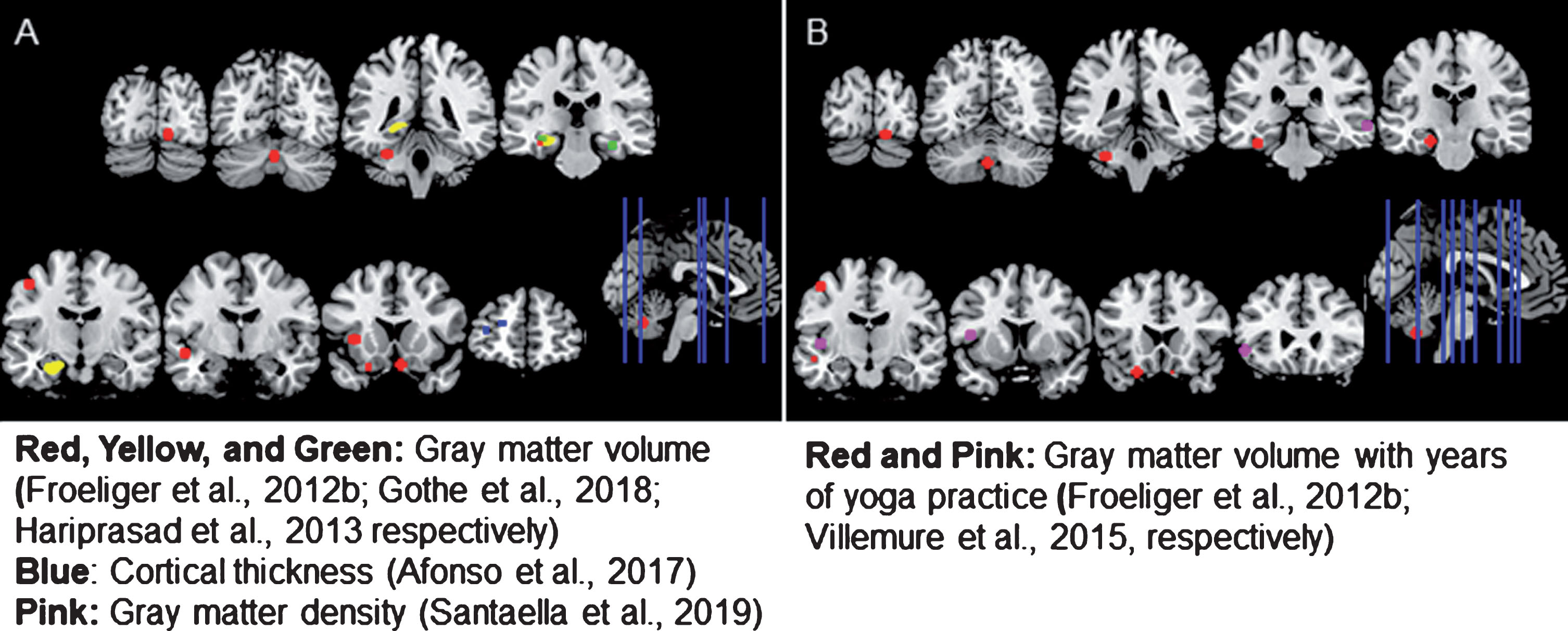 Brain regions showing A) structural differences in yoga-practitioners compared to non-practitioners or B) a dose-dependent relationship between years of yoga practice and brain structure among practitioners. Yoga practitioners exhibited greater cortical thickness, gray matter (GM) volume, and GM density than non-practitioners in a variety of regions. Among yoga-practitioners, a positive relationship between the years of yoga practice and GM volume was also observed in a number of areas. All but one of the regions shown were created by making a 5 mm sphere around the coordinates provided in the studies reviewed. Since Gothe et al. (2018) did not investigate volume differences on a voxel-wise basis, a mask of the whole structure is shown.