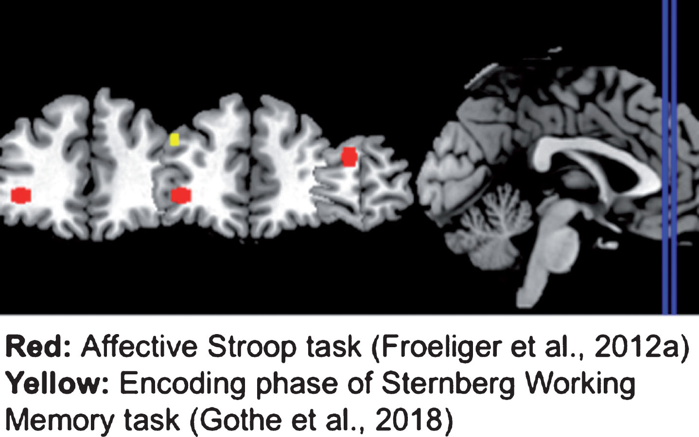 Brain regions showing differential task-related activation in yoga-practitioners. Yoga practitioners showed less activation than non-practitioners in the left dorsolateral prefrontal cortex during the encoding phase of a Sternberg Working Memory task (yellow). Yoga practitioners also showed less activation than non-practitioners in the right dorsolateral prefrontal cortex and right superior frontal gyri, but more activation in the left ventrolateral prefrontal cortex during various aspects of an Affective Stroop task (red). All regions shown were created by making a 5 mm sphere around the coordinates provided in the studies reviewed.