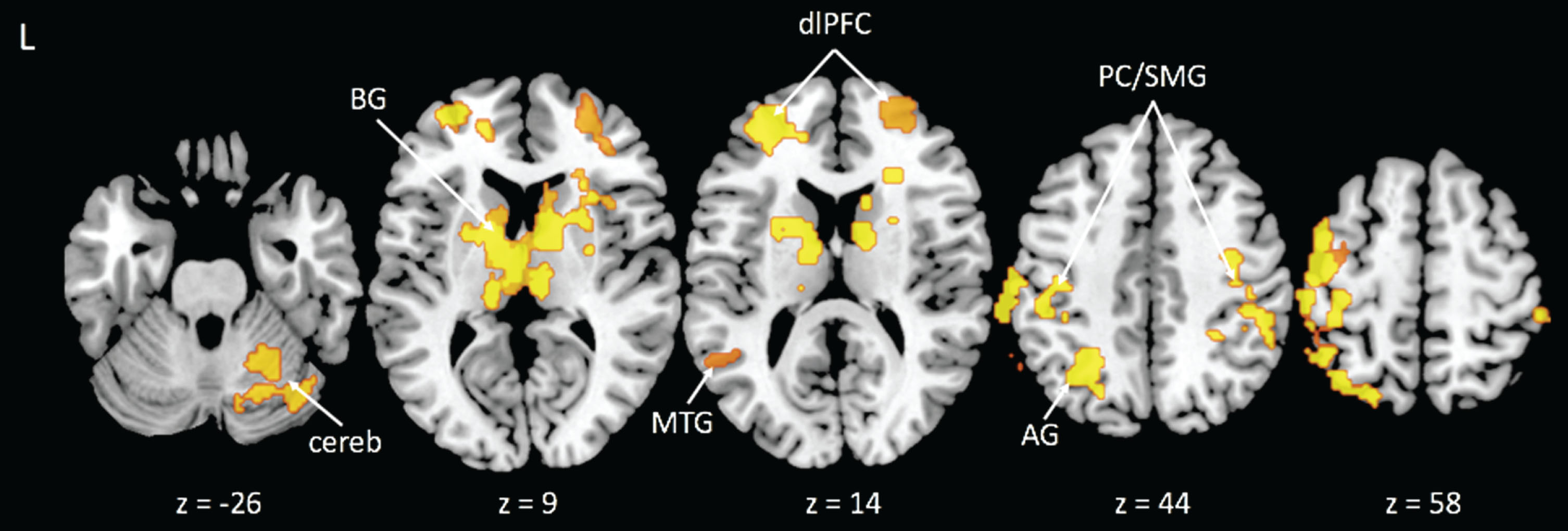 Activation clusters with greater activity related to lower cardiorespiratory fitness during the Incongruent > Congruent condition contrast. Note: BG = basal ganglia; cereb = cerebellum; MTG = middle temporal gyrus; dlPFC = dorsolateral prefrontal cortex; AG = angular gyrus; PC/SMG = postcentral/supramarginal gyri.