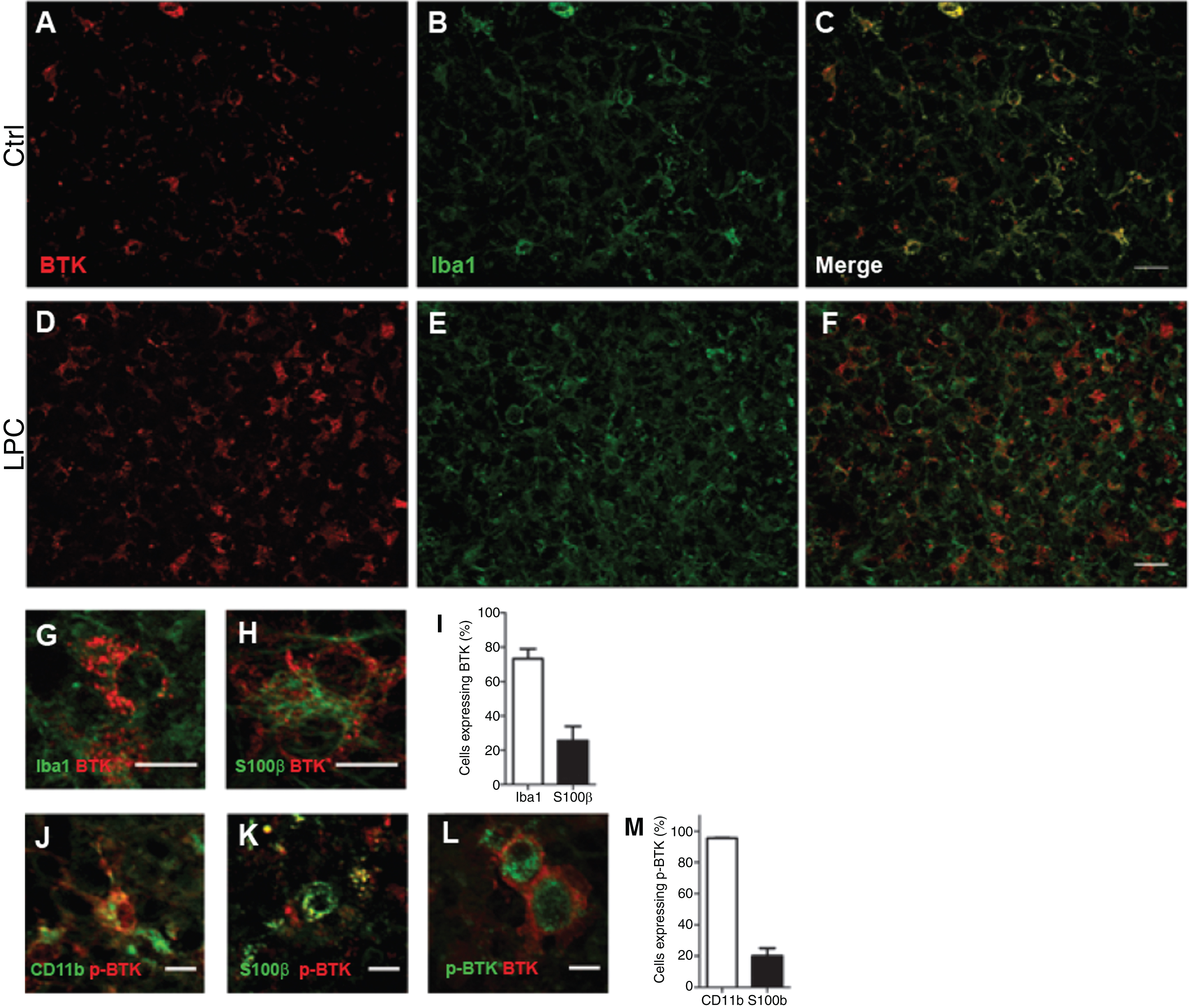 Detection of BTK in microglia and astrocytes. Cerebellar organotypic slices from P9 mouse, were maintained in culture and submitted to LPC treatment at DIV6 for 16–17 h. At DIV9 (i.e., peak of demyelination) immuno staining was performed for BTK (Red) and Iba1 (microglia, green). A–F: Small magnification of control (A–C), and after LPC-induced demyelination (D–F). G,H,J, and K: Higher magnification illustrating co-localisation of BTK and p-BTK in microglia labeled with Iba1 (G) or CD11-F4/80-CD68 (J) and astrocyte S100ß+ (H, K).L: An example of two cells co-expressing BTK and p-BTK. Note that BTK is more at the surface while p-BTK is more intracytoplasmic. I and M: Quantification of microglia and astrocytes expressing BTK (I) or p-BTK (M). Scale bars: A–F = 20 μm; G,H, J,K, and L = 10 μm.