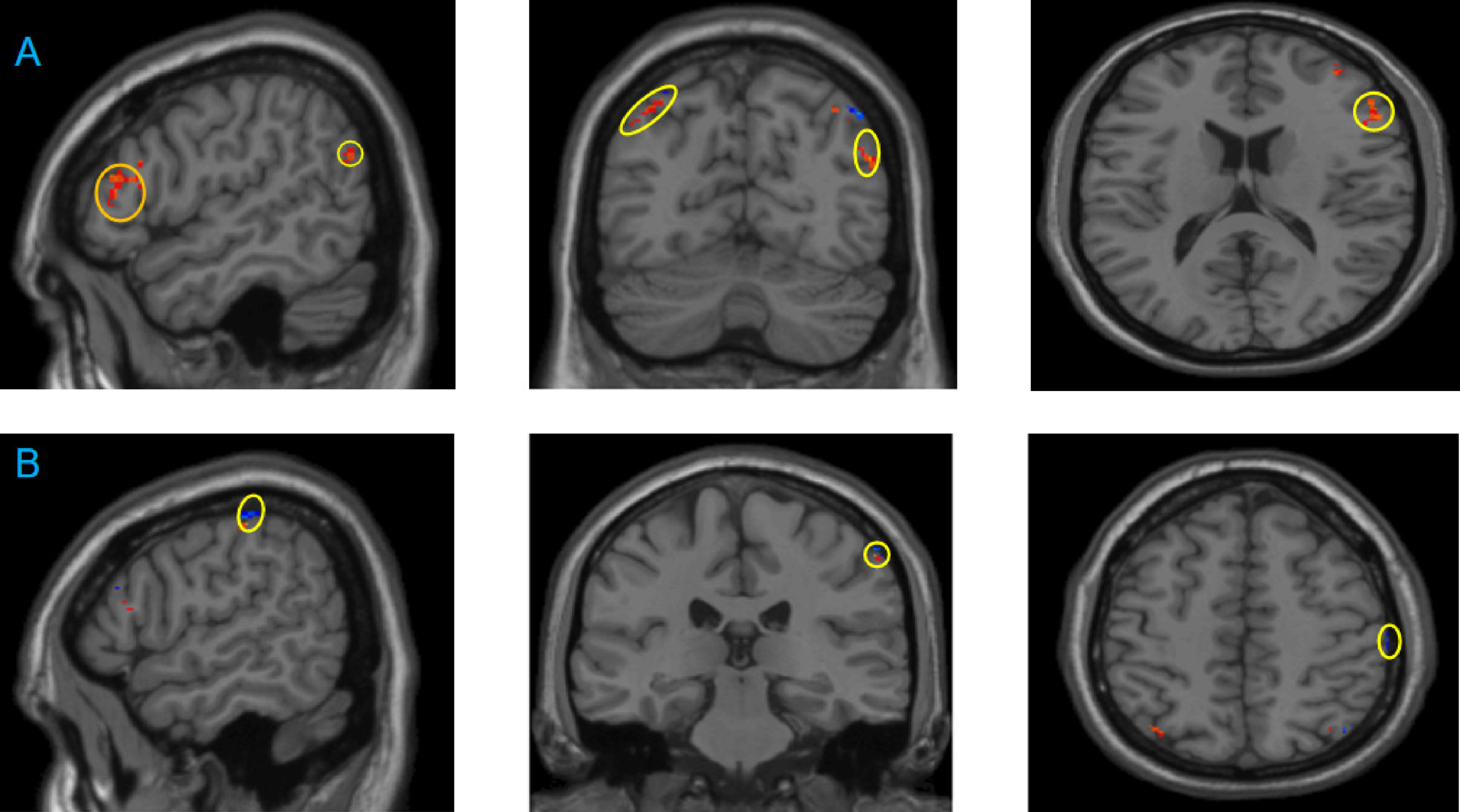 Difference of gray matter density between the Baduanjin (BDJ) group and usual physical activity (UPA) control group before and after intervention. A: Brain areas with increased gray matter volume before and after intervention in the BDJ group compared with the UPA group: Left superior temporal gyrus, medial temporal gyrus, right superior frontal gyrus, middle frontal gyrus, right medial frontal gyrus, right temporal medial gyrus, occipital medial lobe, left cingulate gyrus, left superior parietal gyrus, right inferior parietal gyrus, angular; B: right parietal lobe and posterior central gyrus showed decreased gray matter volume in the BDJ group compared with the UPA group.