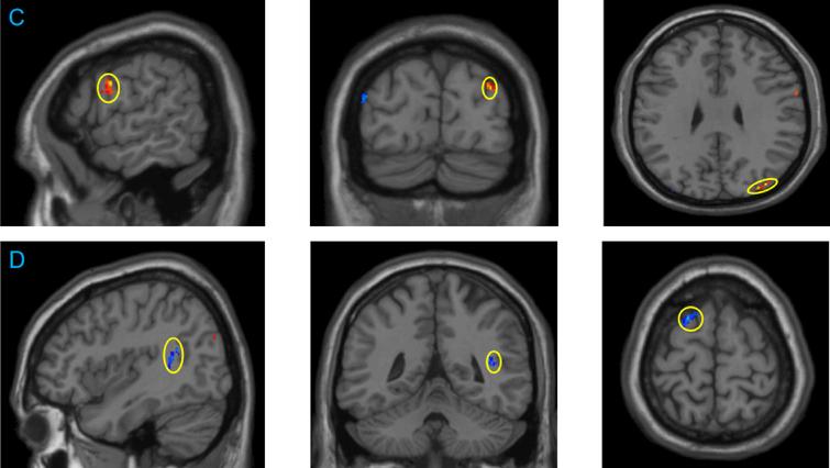 Difference in gray matter density between the Baduanjin (BDJ) group and the brisk walking (BWK) group before and after the intervention. C: Brain areas with increased gray matter volume in the BDJ group compared with the BWK group: Right frontal lobe, right precentral Gyrus, right supraital Occipital gyrus, right occipital middle gyrus, right frontal lobe; D: compared with the BWK group, there was a decrease in gray matter volume in the BDJ group before and after the intervention: right cerebellar posterior lobe, right superior temporal gyrus, right occipital lobe, right precuneus lobe, left superior occipital gyrus, left superior frontal gyrus.