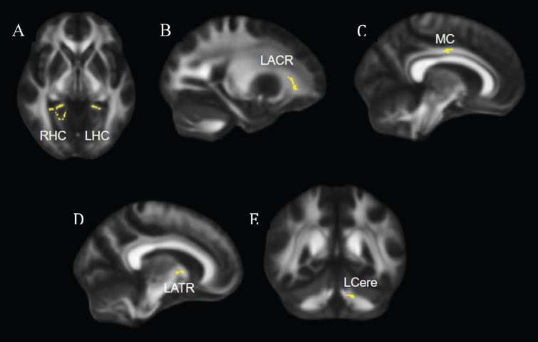 Regions that showed significant increase in FA at post-intervention compared to pre-intervention. (A) Axial view, significant clusters in bilateral hippocampal cingulum. (B, C, D) Sagittal views, significant clusters shown in left anterior corona radiata (B), middle cingulum (C), and left anterior thalamic radiation (D). (E) Coronal view, significant clusters shown in the left cerebellum. FA = fractional anisotropy; LHC = left hippocampal cingulum; RHC = right hippocampal cingulum; LACR = left anterior corona radiata; MC = middle cingulum; LATR = left anterior thalamic radiation; LCere = left cerebellum.
