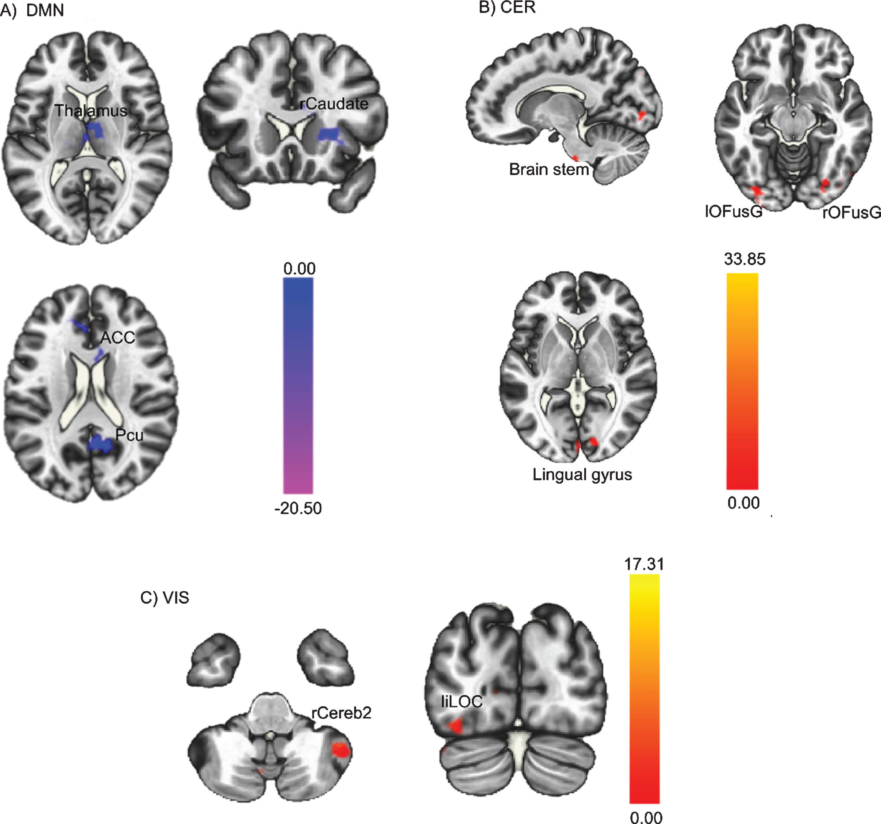 Whole-brain level paired sample t-test results of FC differences between pre- and post-intervention. Red regions indicated increased FC after the PA-intervention and blue regions indicated decreased FC after the PA-intervention. (A) Decreased DMN FC; (B) Increased CER FC; (C) Increased VIS FC. The threshold was set as uncorrected p < 0.01 at the whole brain level, and reported regions survived at pFDR < 0.05 at the cluster level. FC = functional connectivity; PA = physical activity; DMN = posterior default mode network; CER = cerebellar network; VIS = visual network.
