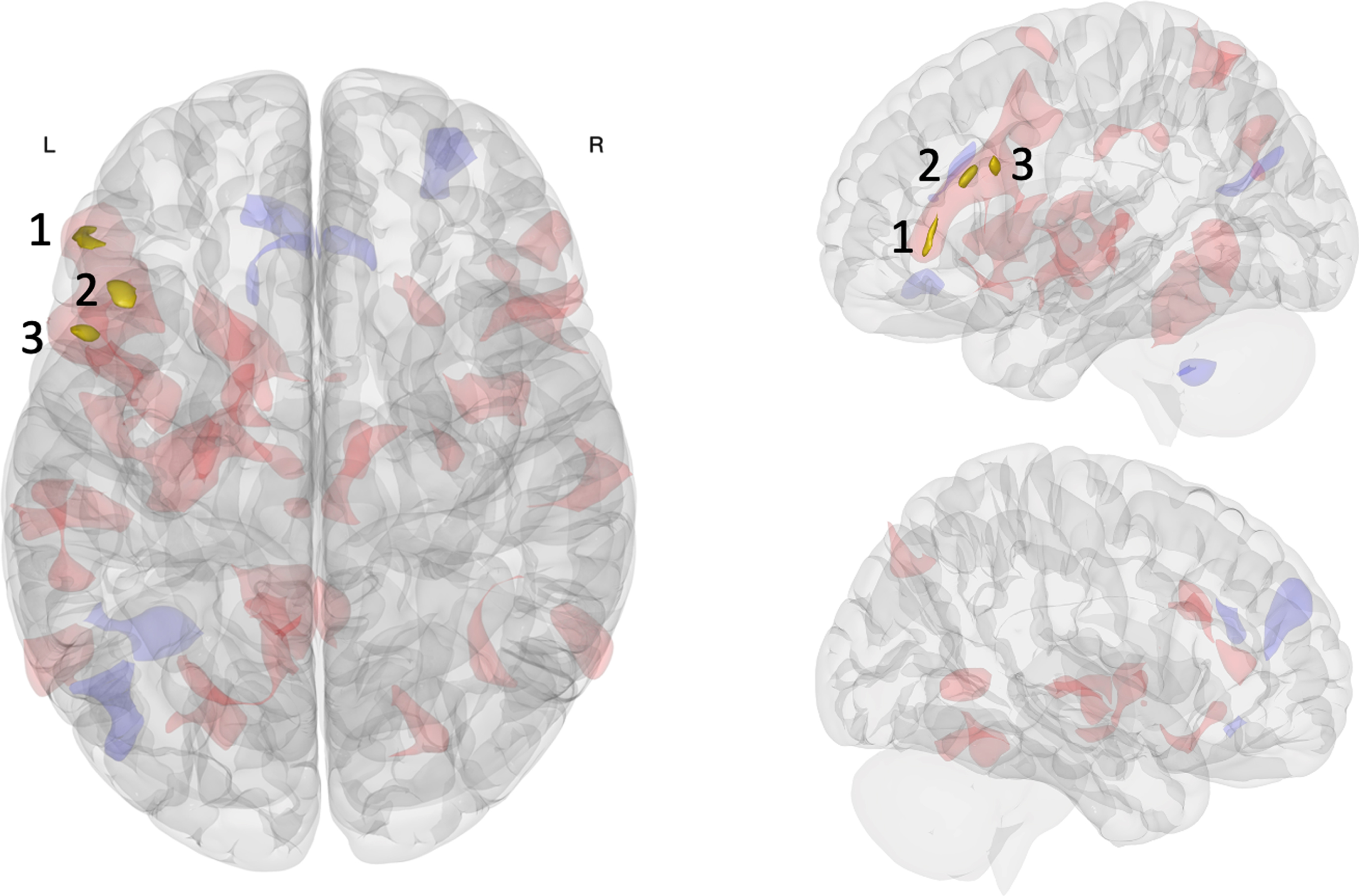 Multivariate analysis of resting-state functional connectivity results. Three clusters in the left FPN were associated with pre-to-post connectivity changes between the acute exercise and seated reading control conditions: inferior frontal gyrus pars triangularis (cluster 1), middle frontal gyrus (cluster 2), inferior frontal gyrus pars opercularis (cluster 3). Opaque gold clusters represent significant differences in rsFC change (voxel p<0.001; FDR-corrected cluster threshold p<0.05; k≥50). Shaded red (positive) and blue (negative) clusters show the broader pattern of rsFC change (post >  pre; exercise >  control) with an uncorrected significance threshold (voxel/cluster p <  0.05).