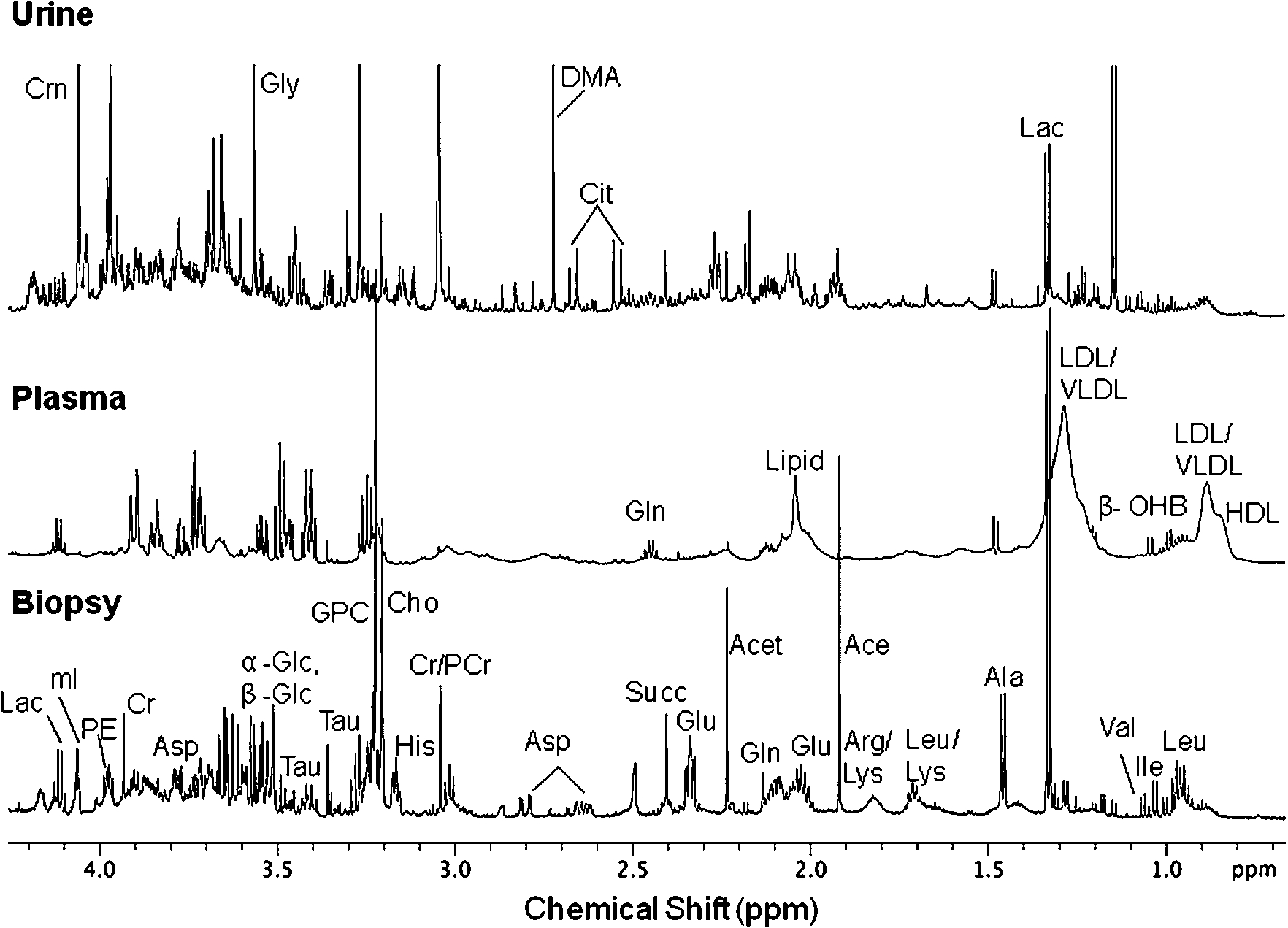 Expanded aliphatic region (0.5–4.2 ppm) of 1D 1H NMR spectra acquired at 700 MHz in D2O at 25°C of (a) perchloric acid extract of intestinal mucosal biopsy, (b) blood plasma, and (c) urine obtained from a patient with CeD. Abbreviations used: HDL – high density lipoprotein; LDL – low density lipoprotein; VLDL – very low density lipoprotein; Leu – leucine; Ile – isoleucine; Val – valine; β-OHB – β-hydroxy-butyrate; Lac – Lactate; Ala – alanine; Lys – lysine; Arg – arginine; Ace – acetate; Glu – glutamate; Gln – glutamine; Acet – aacetoacetate; Succ – succinate; Cit – citrate; DMA – dimethyamine; Asp – aspartate; Cr – creatine; PCr – phosphocreatine; His – histidine; Cho – choline; GPC – glycerophosphocholine; Tau – Taurine; Gly – glycine; Glc – glucose; mI – myo-inositol; Crn – Creatinine; PE – phosphoethanolamine.