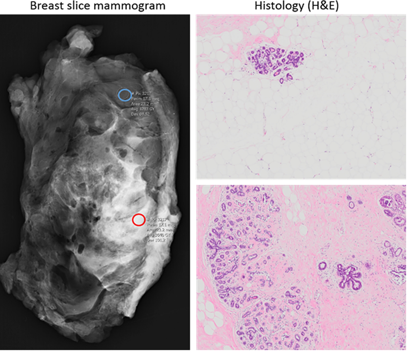 Left panel: Mammogram of breast slice indicating regions of high (red circle) and low (blue circle) mammographically dense tissue. Right panel: Haematoxylin and eosin (H&E) stain of representative low-MD (top) and high-MD (bottom) regions following histological processing (4X objective).