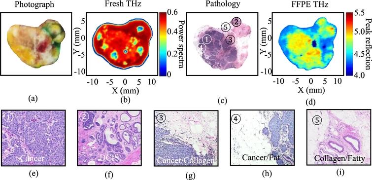 THz images of human breast cancer tissue. (a) The photograph of fresh tissue. (b) The frequency domain THz image of fresh tissue represented in spectral power. (c) The low power pathology image. (d) The time domain THz image of FFPE block tissue. (e) The high power pathology image of cancer region marked as 1 ◯ in (c), (f). The high power pathology image of DCIS region marked as 2 ◯ in (c), (g). The high power pathology image of cancer-collagen region marked as 3 ◯ in (c), (h). The high power pathology image of cancer-fat region marked as 4 ◯ in (c), (i). The high power pathology image of collagen-fatty region marked as 5 ◯ in (c).