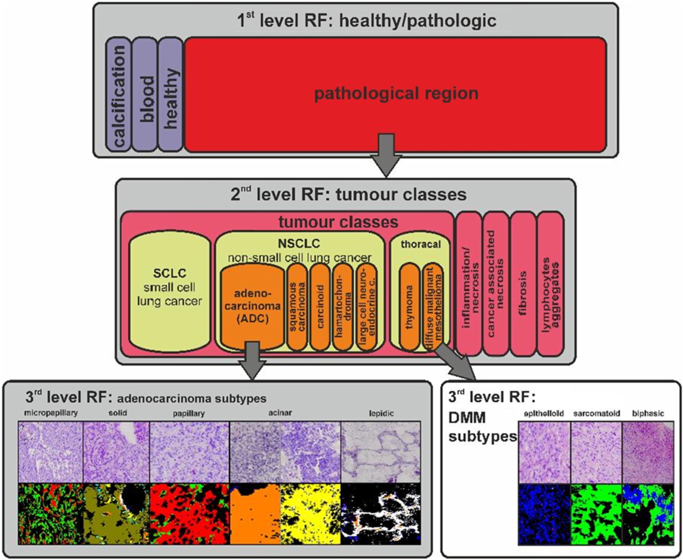 Schematic workflow of the differential FTIR imaging tissue characterization for thoracal tumours. Tissue annotation by FTIR imaging for lung tumours and thoracal tumours is illustrated. In a first classifier, the pathologic regions were identified. In a second classifier, the different tumour classes of the pathologic region are differentiated. Finally, in the third classifier, a differential diagnosis of the tumour subtypes is provided. The classifiers for lung tumours and thoracal tumours (shaded in grey) were previously published by Großerueschkamp, Kallenbach-Thieltges et al. [10]. The classification of DMM subtypes was previously published by Großerueschkamp et al. [9]. The proof that differential diagnostic is possible with IR imaging was an important step for the label-free digital pathology.