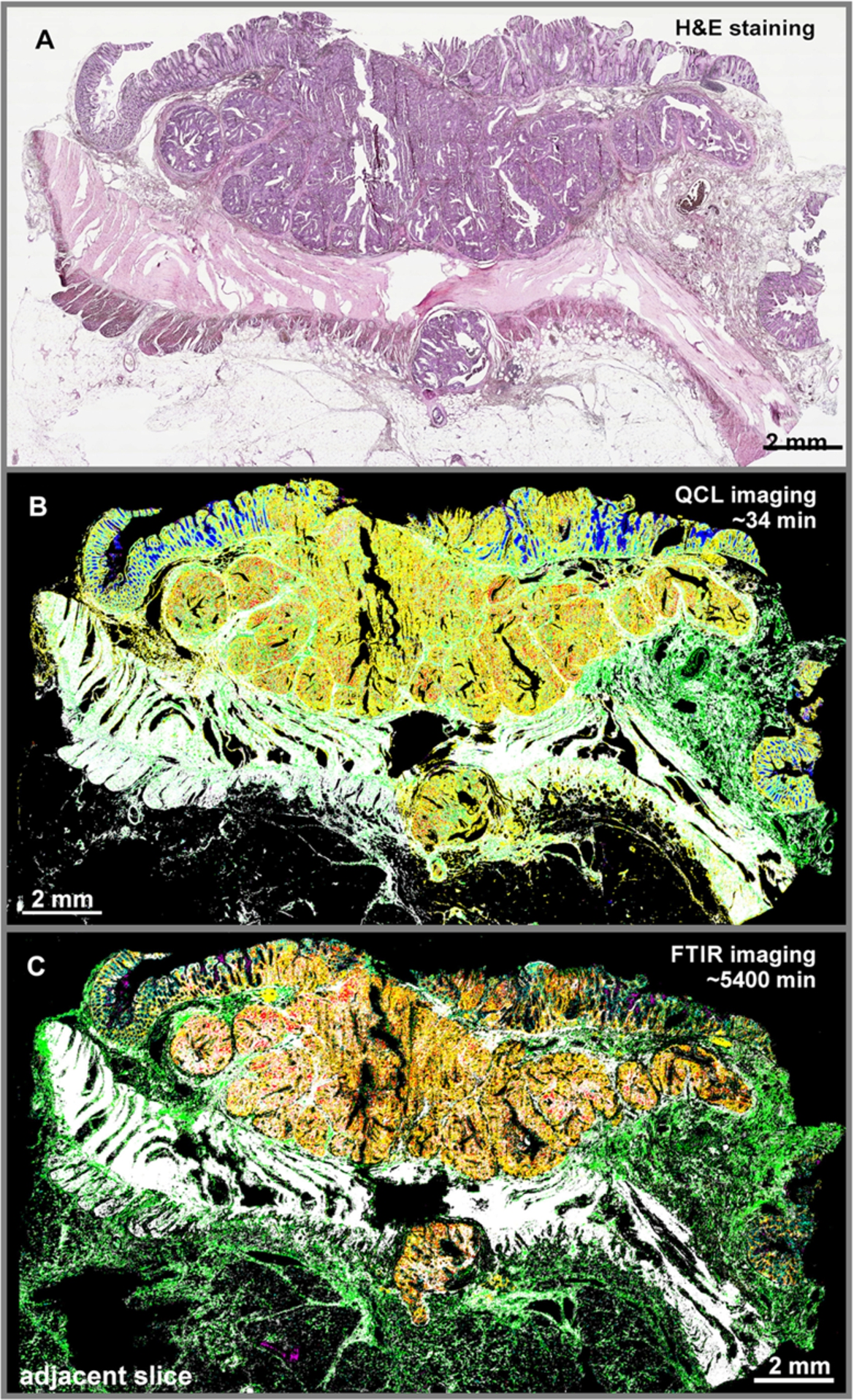 Comparison of the QCL-IR- and FTIR-based IR tissue analysis. Colorectal cancer tissue analysis using H&E staining as Gold standard (A), Spero QT system (B), and FTIR-based imaging system (C). The listed times illustrate the duration of the measurements. Red, pathological region comprising of tumorous regions and infiltrating inflammatory cells; white, muscles; green, connective tissue; cyan, crypts and blue, lumen. The comparison of the images demonstrates convincingly, that the QCL IR imaging results are in nice agreement with those obtained using the FTIR imaging. The observed deviations seem to be caused mainly by the use of an adjacent slice and the training of the FTIR classifier on samples of another study which could slightly differ in sample handling and processing. Furthermore, the previously FTIR classifier is performing the classification in one-step which is less accurate by means of tumor detection. While the improved classifier for the QCL imaging recognizes infiltrating inflammatory cells in the first level random forest (RF) and cancerous regions in the second level RF which allows a much more accurate classification This figure was previously published in the supplement of a paper by Kuepper, Kallenbach-Thieltges et al. [20].