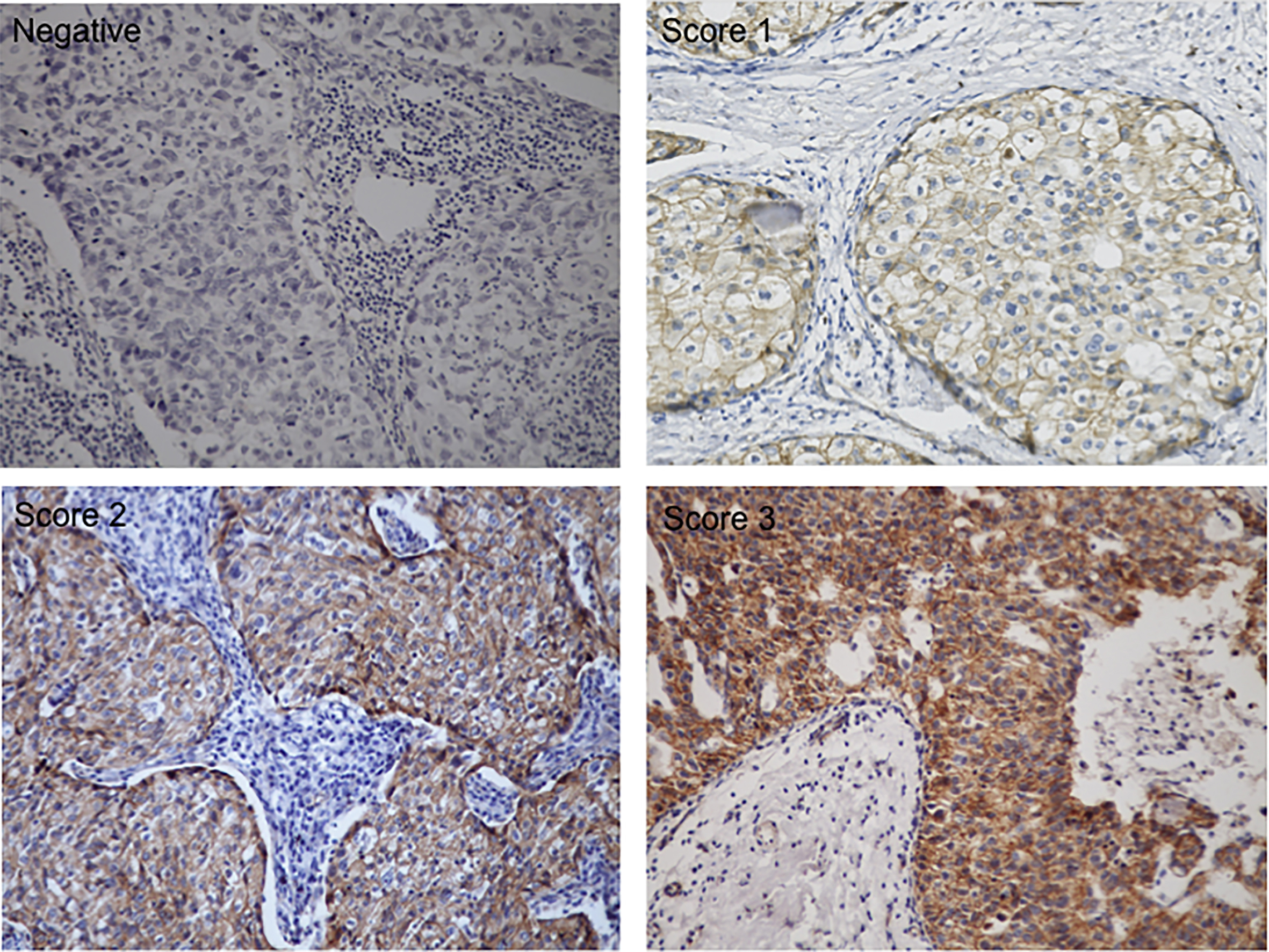 Representative images of β-catenin expression in breast cancer sections (magnification, x200). Scores of 1 to 3 were defined according to the immunohistochemical intensity of β-catenin.