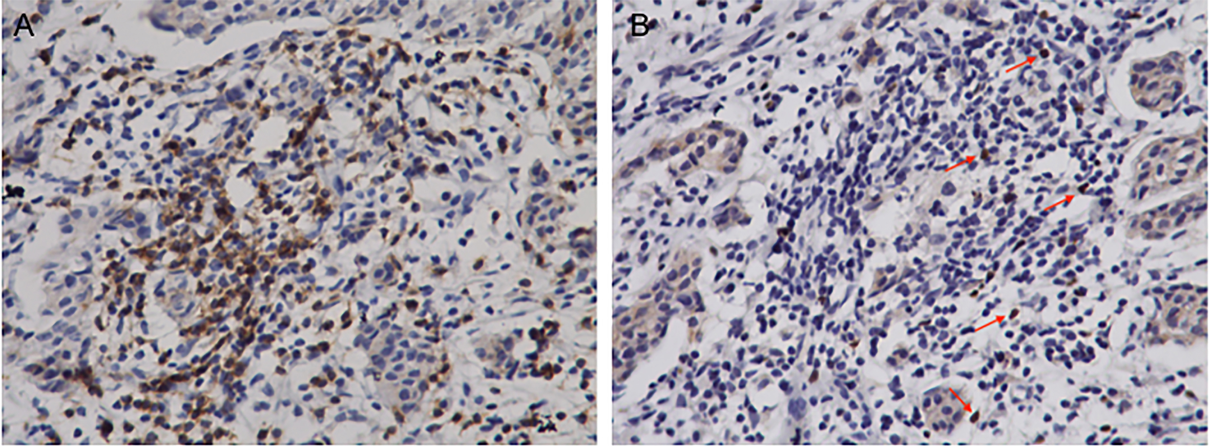 Representative immunohistochemistry staining of stromal CD8+ and FOXP3+ T cell infiltrates in breast cancer (magnification, x400). Consecutive sections were used for immunohistochemical detection of FOXP3+ (A) and CD8+ cells (B).