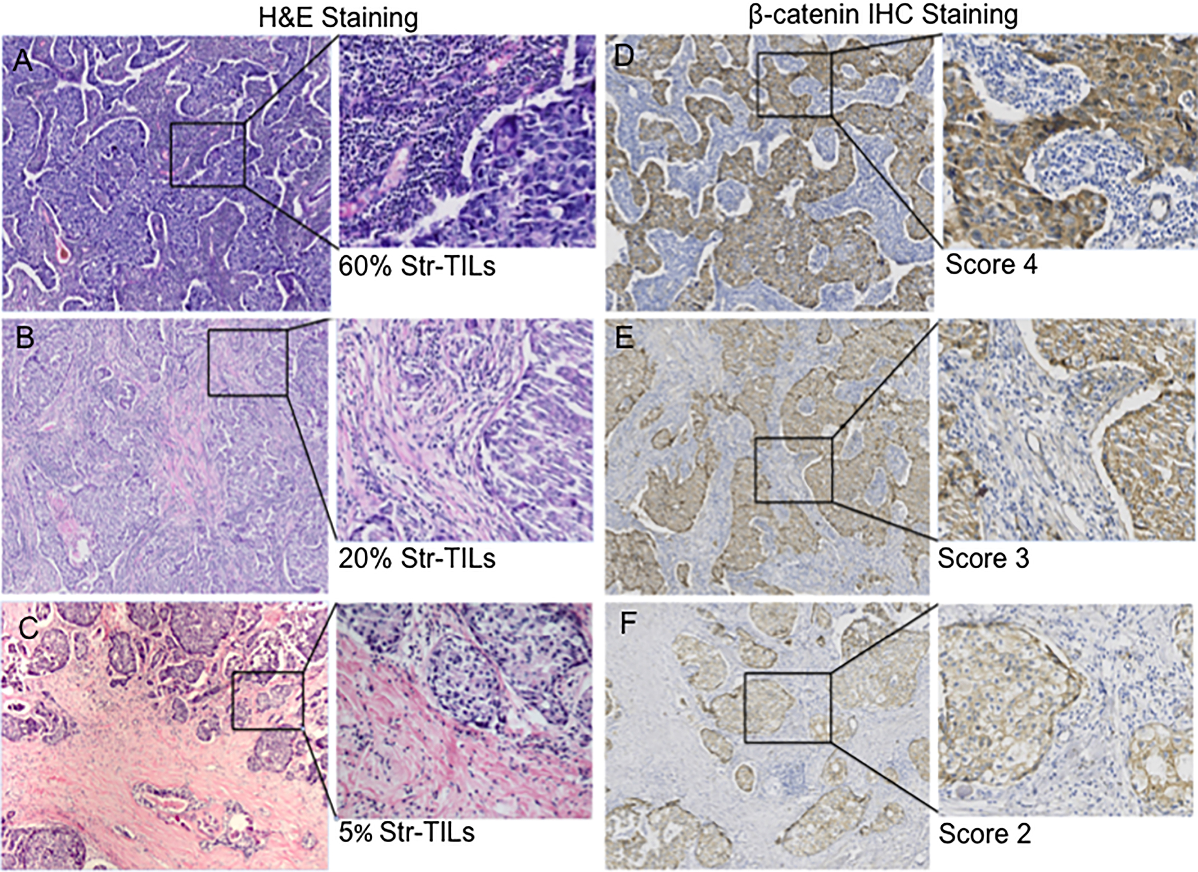 Correlation between TILs and β-catenin in breast cancer. Consecutive sections were used for immunohistochemical detection of TILs distribution and β-catenin expression in breast cancer specimens, and cells were evaluated in the same chosen area of the serial sections. Representative images (A–C) show different levels of lymphocyte infiltration in tumor stroma by H&E staining. TILs are reported as the percentage of area occupied by mononuclear inflammatory cells over total intratumoral stromal area, within the borders of the invasive tumor. Corresponding sections were stained with β-catenin antibody by standard IHC techniques (D–F). Scores shown are final staining scores defined according to the H score of cytoplasmic β-catenin expression.