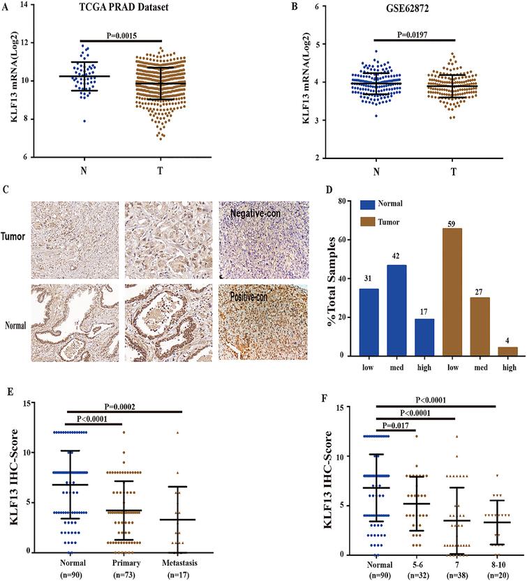 KLF13 is downregulated in PCa tissues. (A) KLF13 expression in PCa tissues from TCGA prostate adenocarcinoma dataset (Normal, n= 52; Tumor, n= 497). (B) KLF13 expression in GEO dataset (Normal, n= 160; Tumor, n= 160). (C) Representative IHC staining of KLF13 in prostate adenocarcinoma and their adjacent non-tumor tissues (Normal, n= 90; Tumor, n= 90), original magnification 200 × and 400 ×. (D) Percentage of KLF13 high-, medium-, and low-staining in normal and carcinoma samples. (E) KLF13 expression levels in primary and metastatic PCa tissues. (F) KLF13 expression levels in PCa tissues in three groups (Gleason score sum 5–6, 7, 8–10).