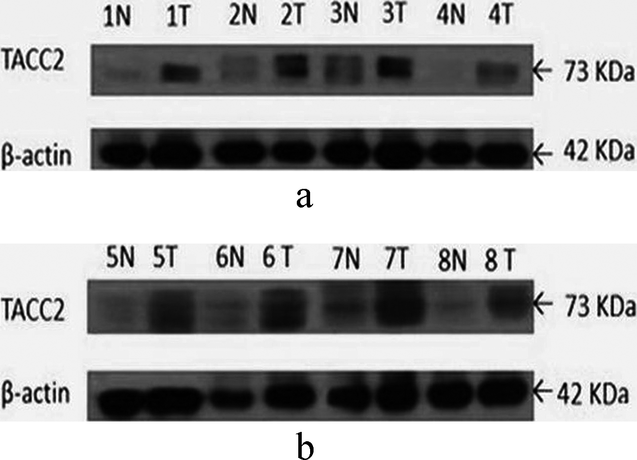 Protein expression of TACC2 in 8 pairs of HCC and adjacent normal tissues determined by western blot. N, normal tissue; T, tumor tissue.