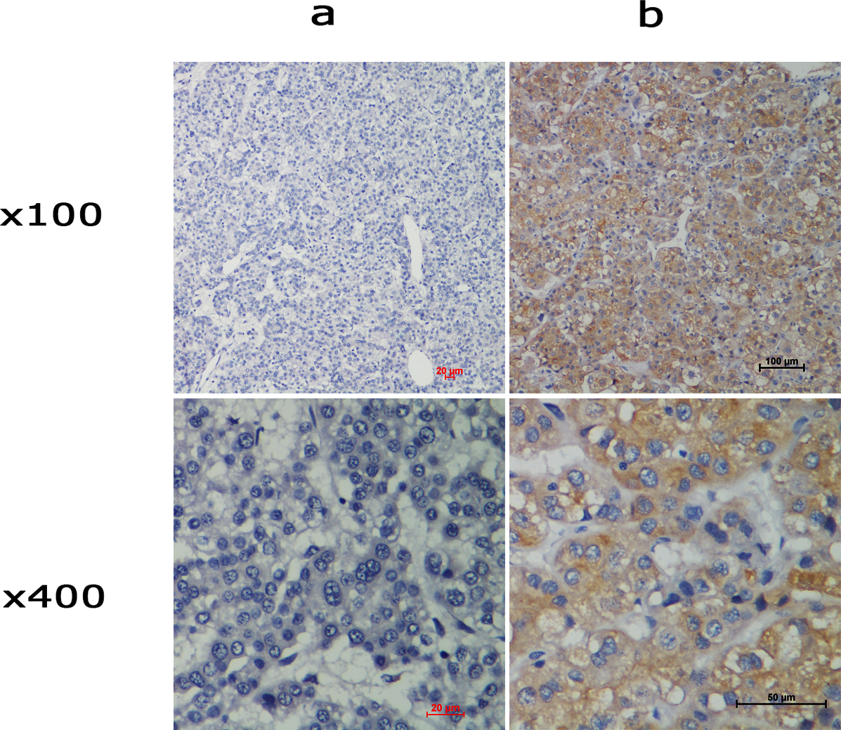 Representative images of TACC2 expression in normal and HCC tissues via IHC. (a and b) TACC2 was absent in adjacent normal cells, whereas it was positively detected in HCC cells (magnification, x100 and x400).