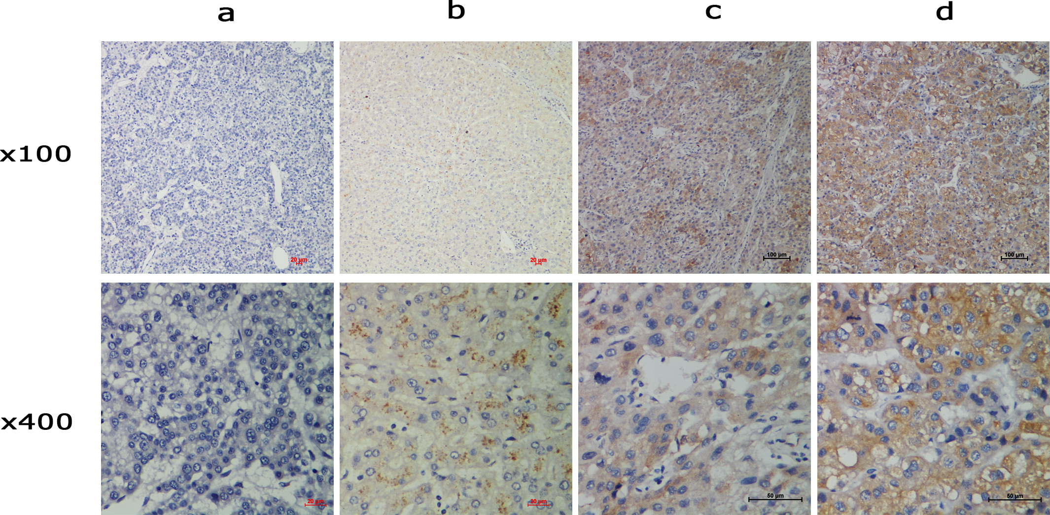 Expression of TACC2 in HCC tissues by immunohistochemistry staining. (a) negative staining, (b) weak staining, (c) moderate staining, and (d) strong staining (original magnification, x100 and x400).